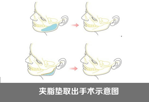 颊脂垫切除术适应症