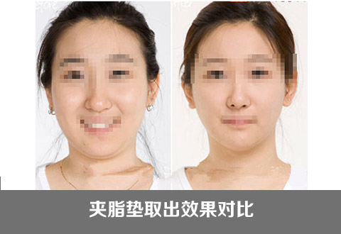 瘦脸的方法介绍